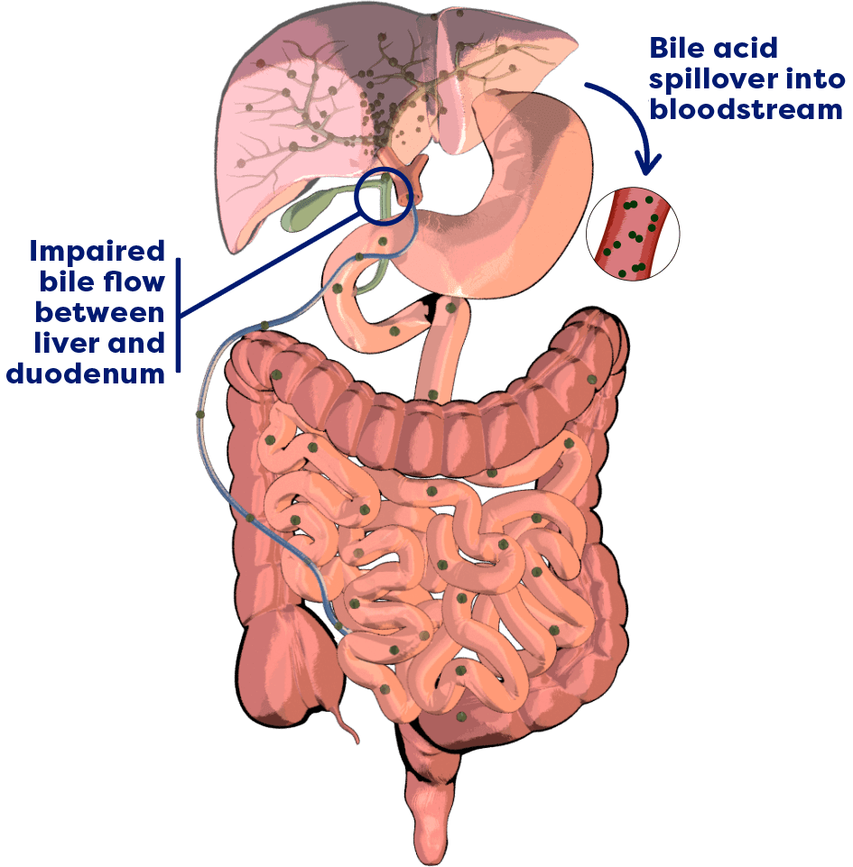 Impaired bile flow between liver and duodenum