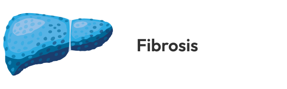 A spotted blue liver illustrating fibrosis due to elevated bile acid.